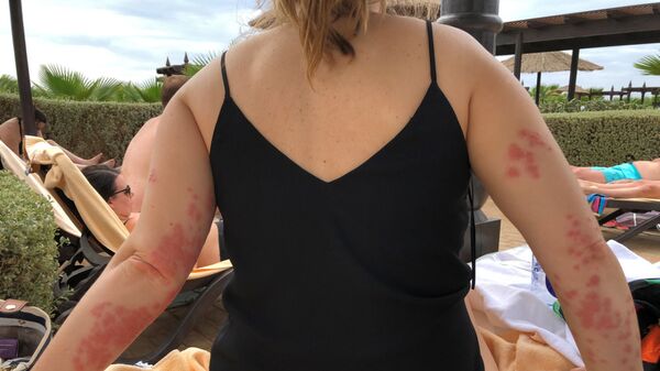 Элейн Вишарт была покусана клопами во время отдыха Элейн Вишарт была покусана клопами во время отдыха