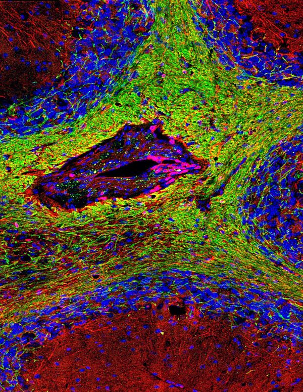 Типичная бляшка в тканях мозга, которая указывает на рассеянный склероз