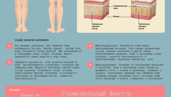 Что такое целлюлит и как с ним бороться Что такое целлюлит и как с ним бороться